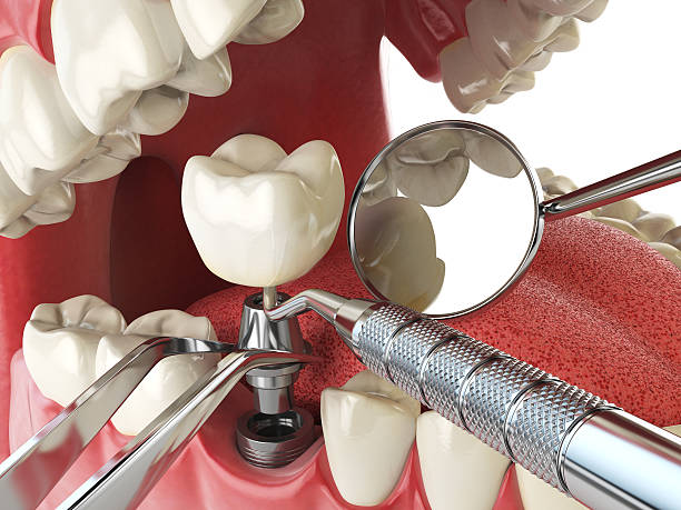 Best Emergency Tooth Extraction in Northwood, OH